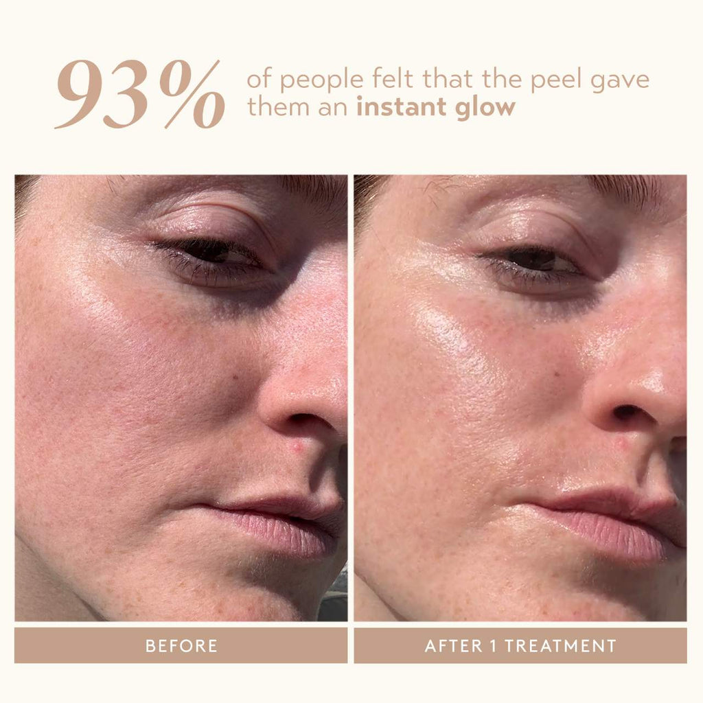 Triple Acid Signature Peel 8 Treatments